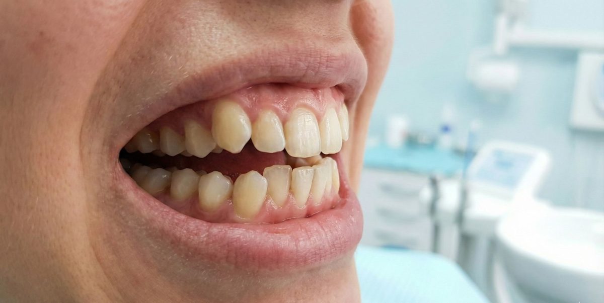 prostowanie zębów u dorosłych